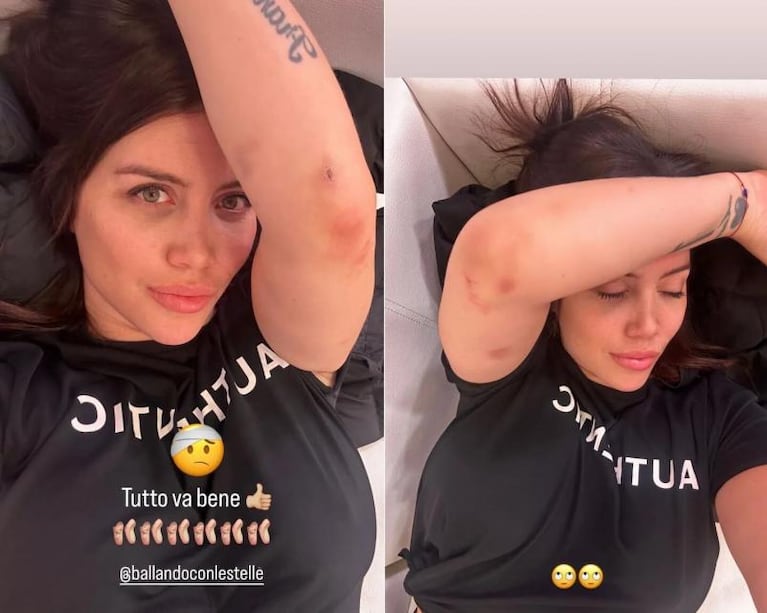 Wanda Nara se mostró con moretones y sus seguidores se preocuparon por su salud